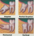/album/wisdom-teeth/wisdome-tooth-1-jpg/